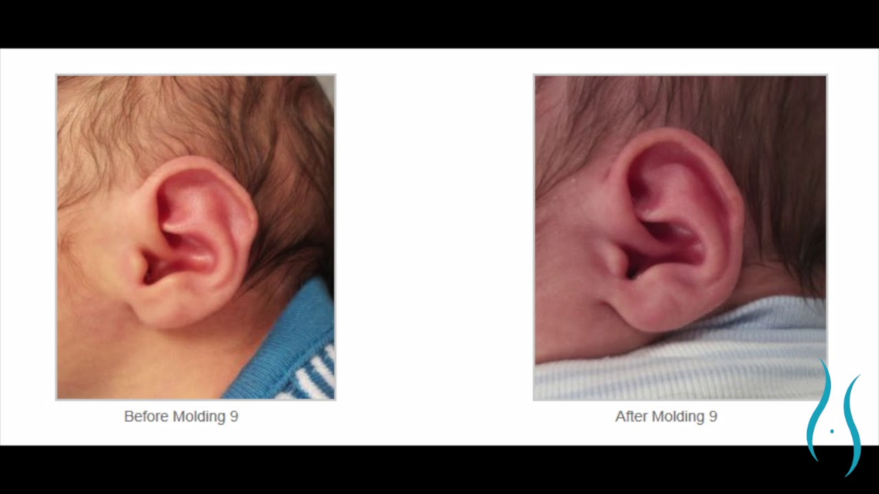 Infant Ear Molding for Newborn Ear Deformities in Connecticut