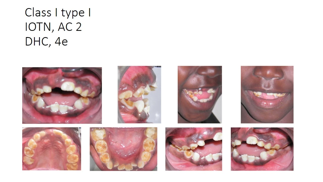 Practical Exercises- Classification of Malocclusion & IOTN INDEX