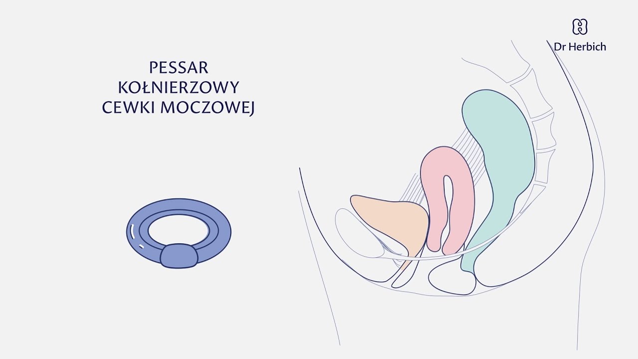Jak działa pessar kołnierzowy cewki moczowej przy nietrzymaniu moczu?