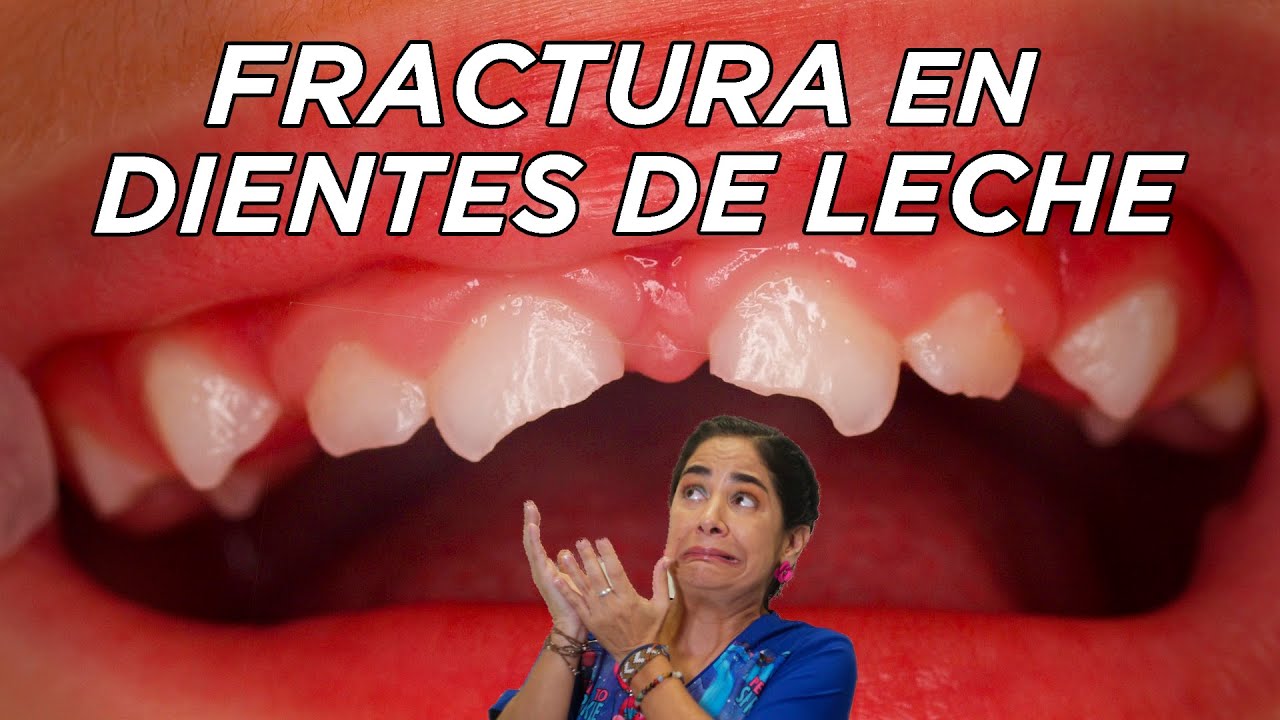 Rotura de dientes de leche