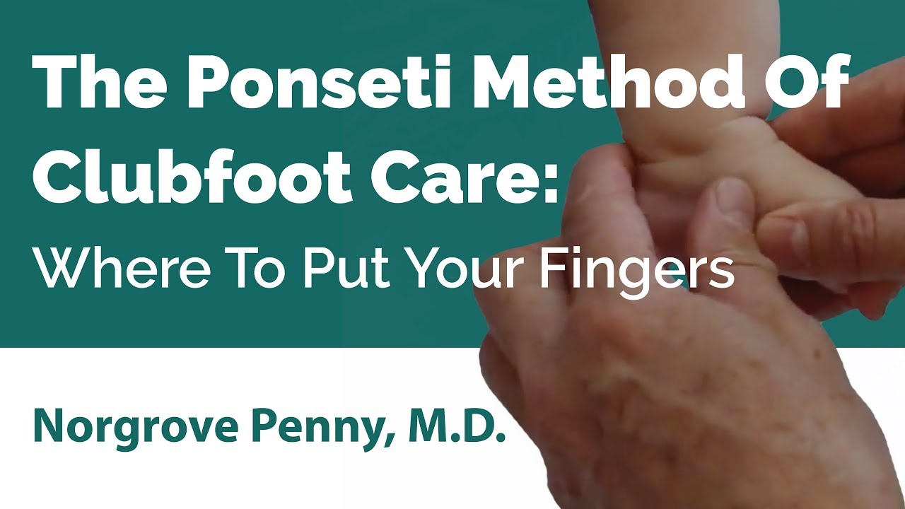 The Ponseti Method Of Clubfoot Care׃ Where To Put Your Fingers