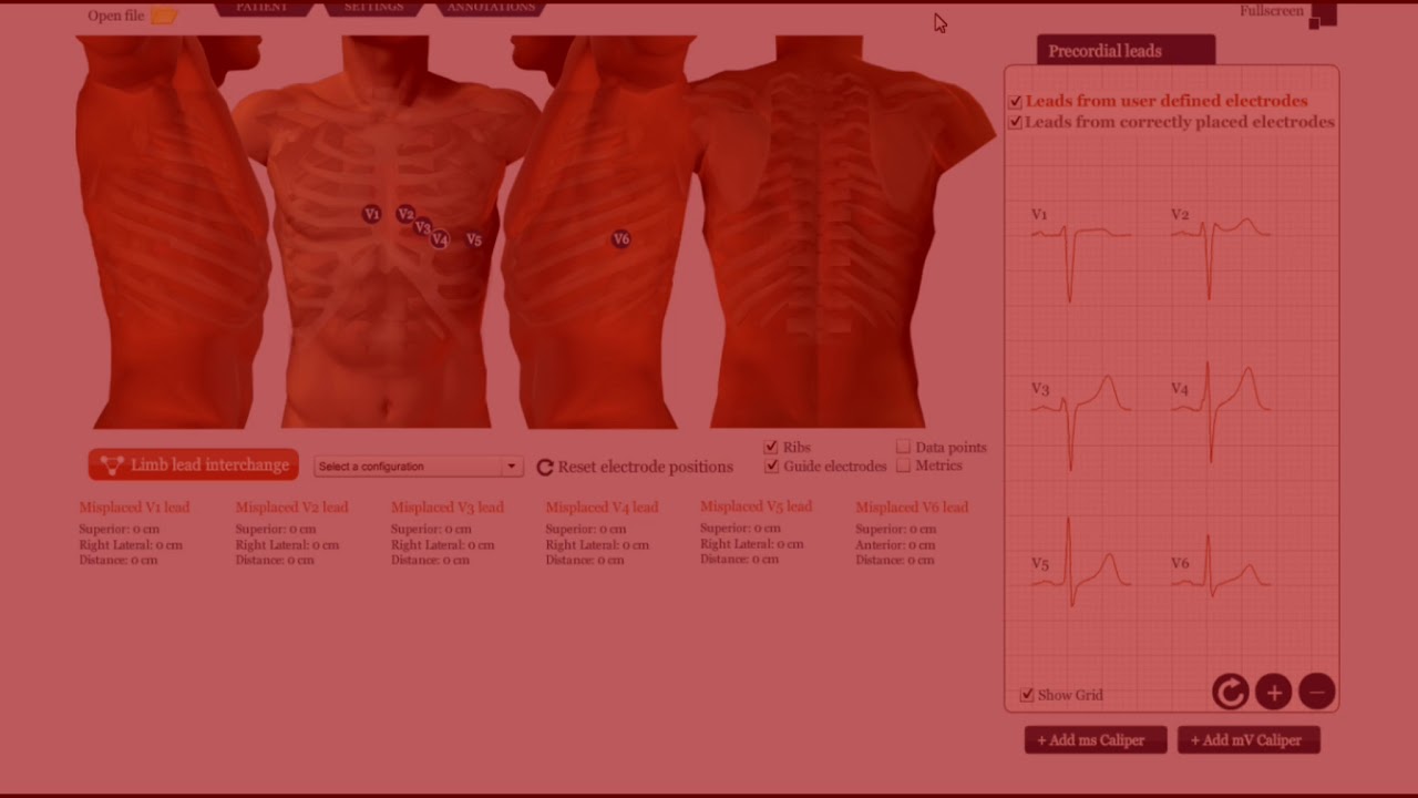 Errores en la realización del electrocardiograma: electrodos y cables