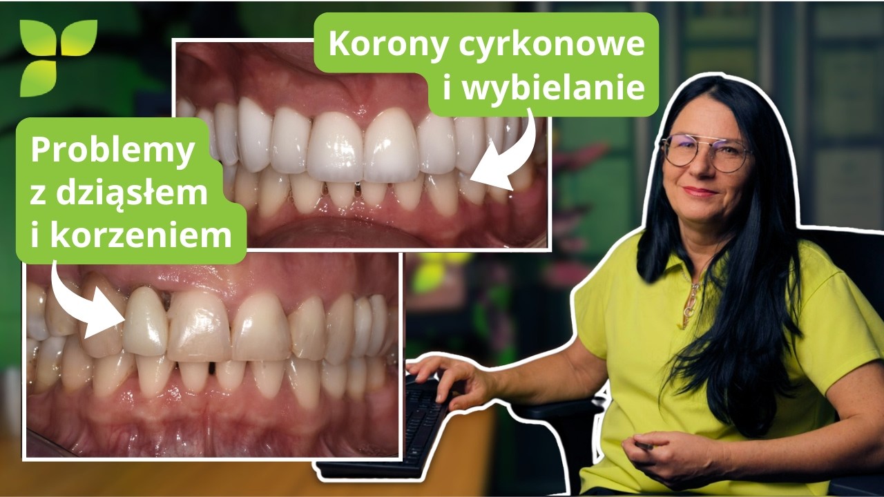 Korony i lic&oacute;wki porcelanowe. Poprawa estetyki uśmiechu - studium przypadku (54)