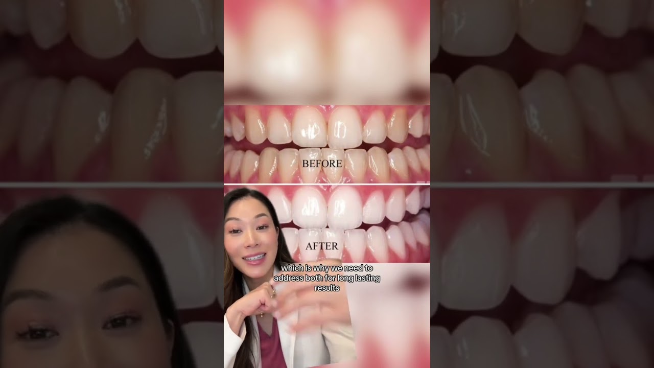 What whitening products work for different stains on teeth. #teethwhitening #dentist #whiteteeth