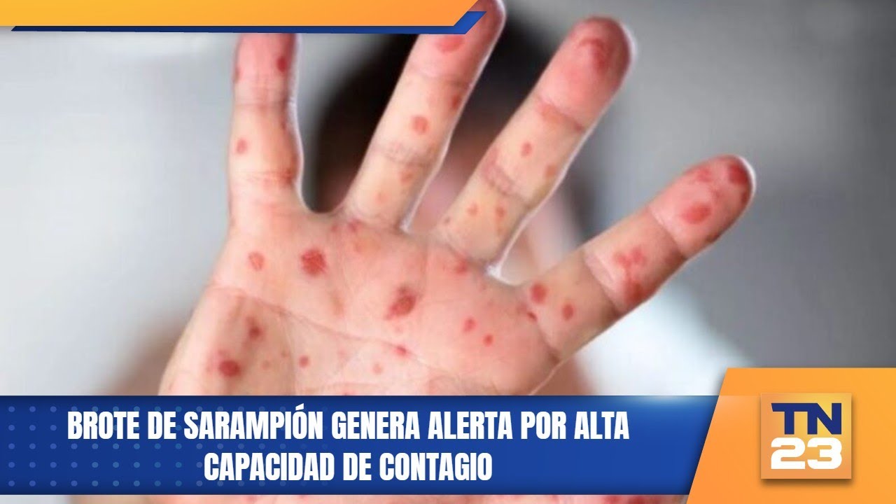 Brote de sarampión genera alerta por alta capacidad de contagio