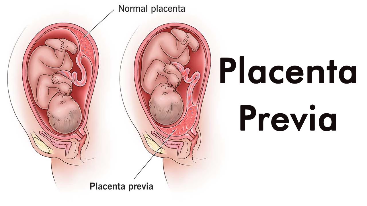 All about Placenta Previa (Urdu/Hindi)
