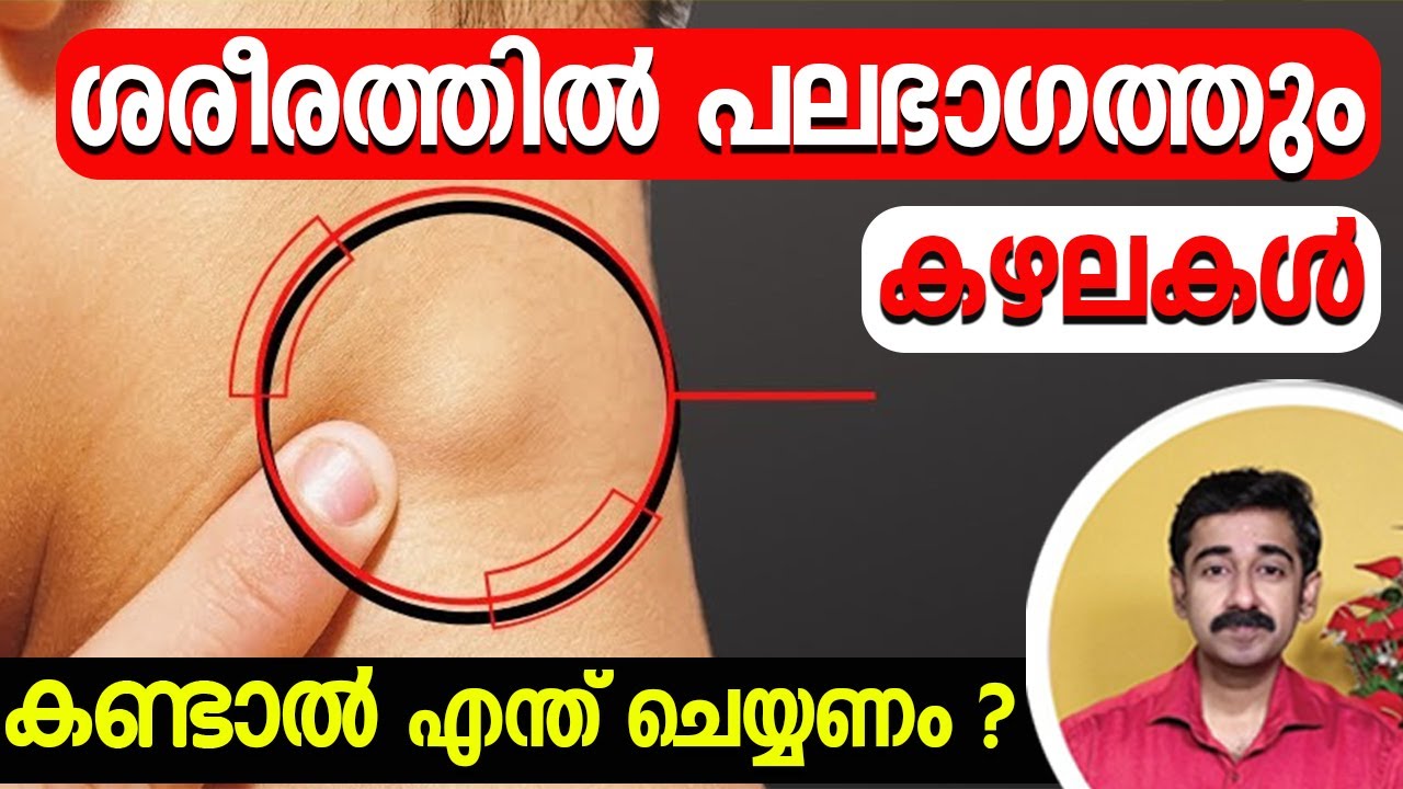 ശരീരത്തിൽ പലഭാഗത്തും കഴലകൾ കണ്ടാൽ ഉടൻ എന്ത് ചെയ്യണം ?