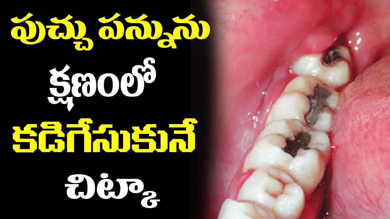 పుచ్చు పన్నును నయం చేసుకునే పద్ధతి || Pucchu Pannu Nayam Chesukune Vidanam || Teeth Cavity Treatment