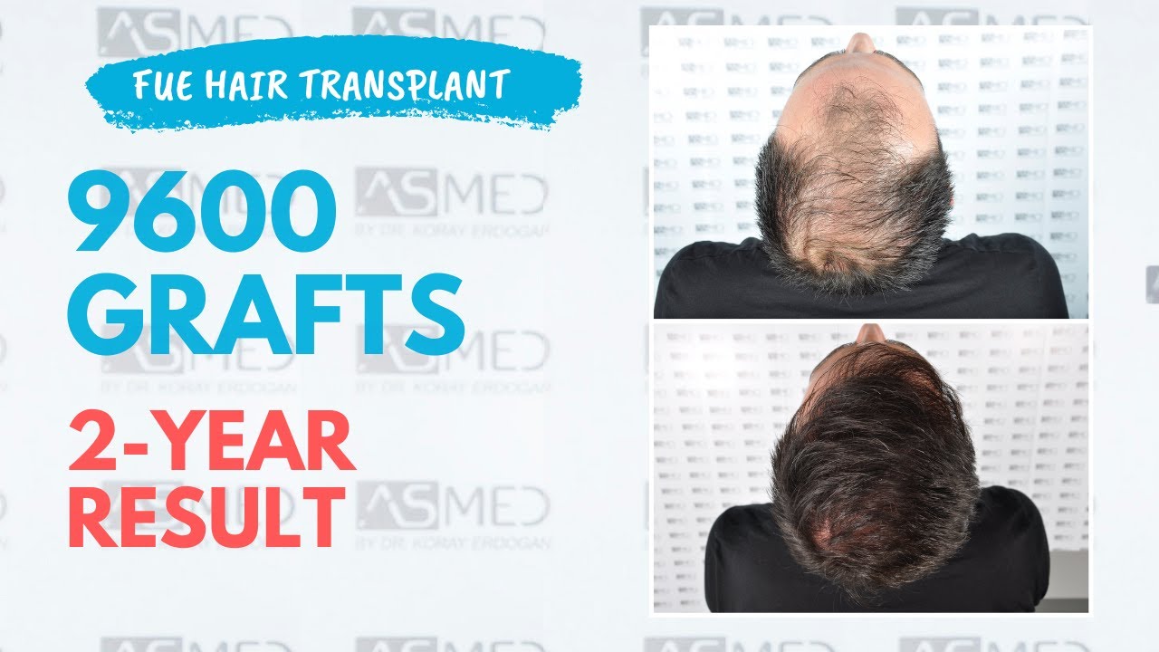 Manual FUE Hair Transplant Before & After 9600 Grafts 2-Year Result - ASMED - Dr. Koray Erdogan