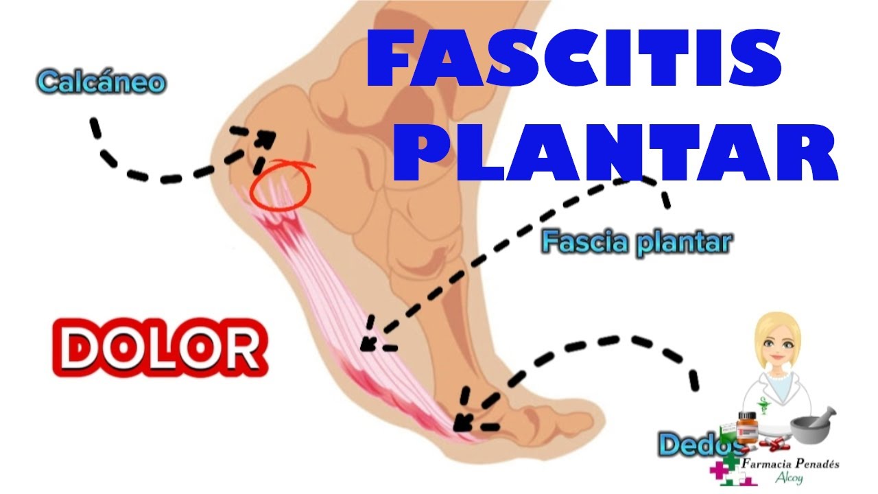 FASCITIS PLANTAR en menos de ¡5 MINUTOS!