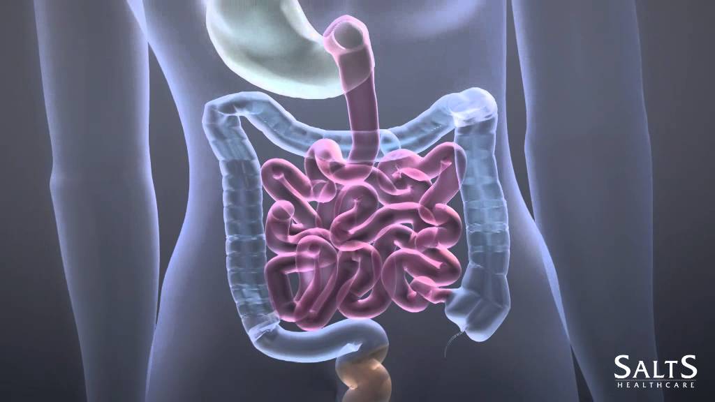 What is a Colostomy?