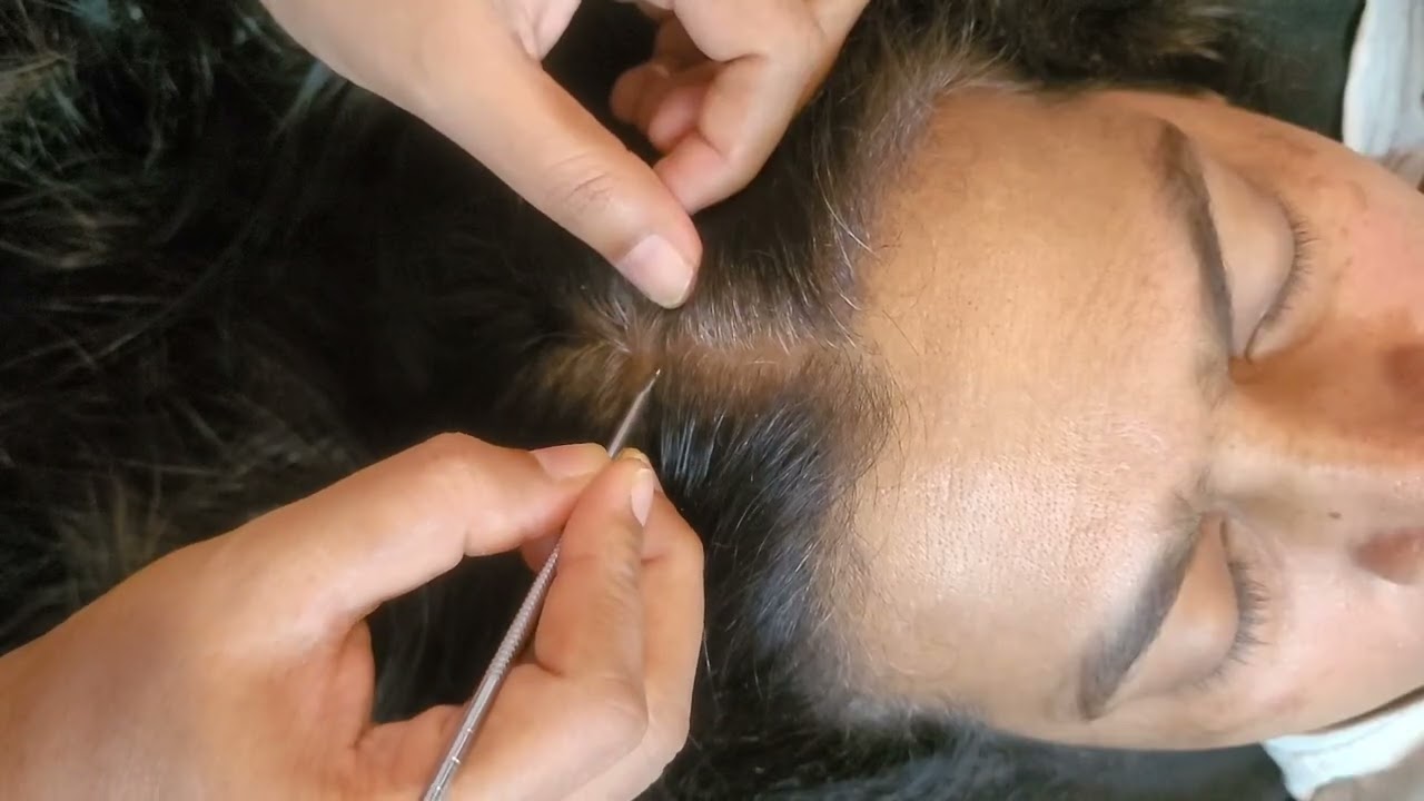 Scalp Checking ASMR , Guarenteed Tingles For People Who NEED Instant Sleep ✨