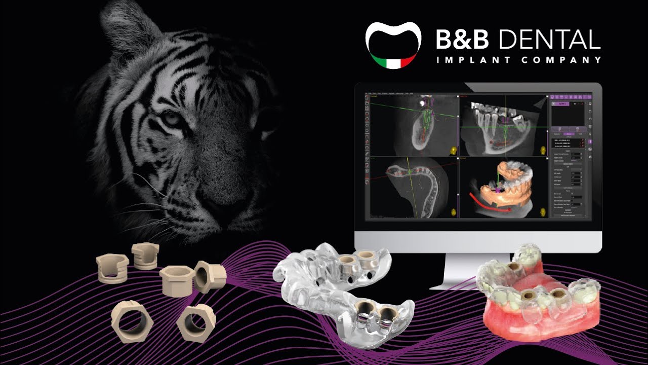 B&B Dental | How to fix sleeves into a template