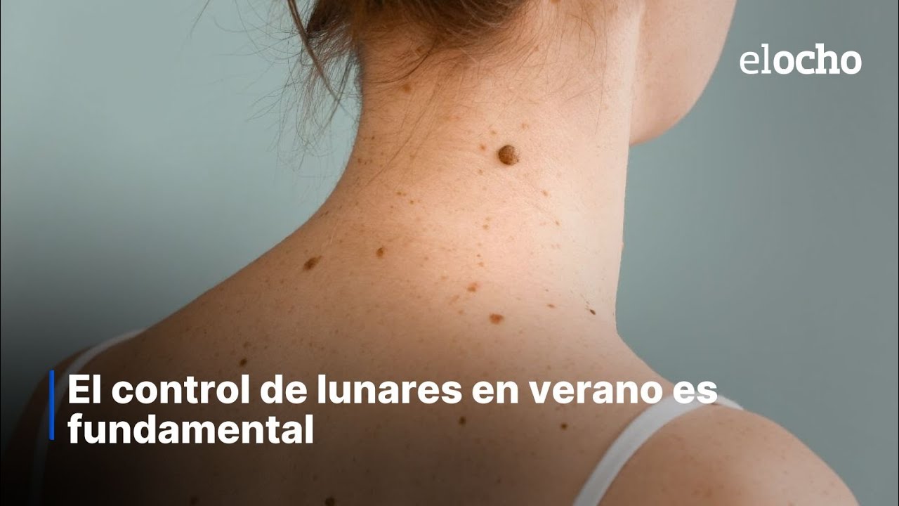 EL CONTROL DE LUNARES EN VERANO ES FUNDAMENTAL
