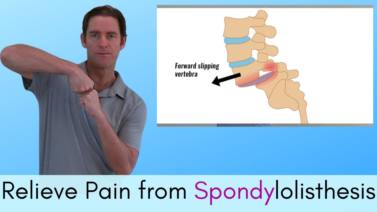 The Best Spondylolisthesis Treatment, Exercises and Information