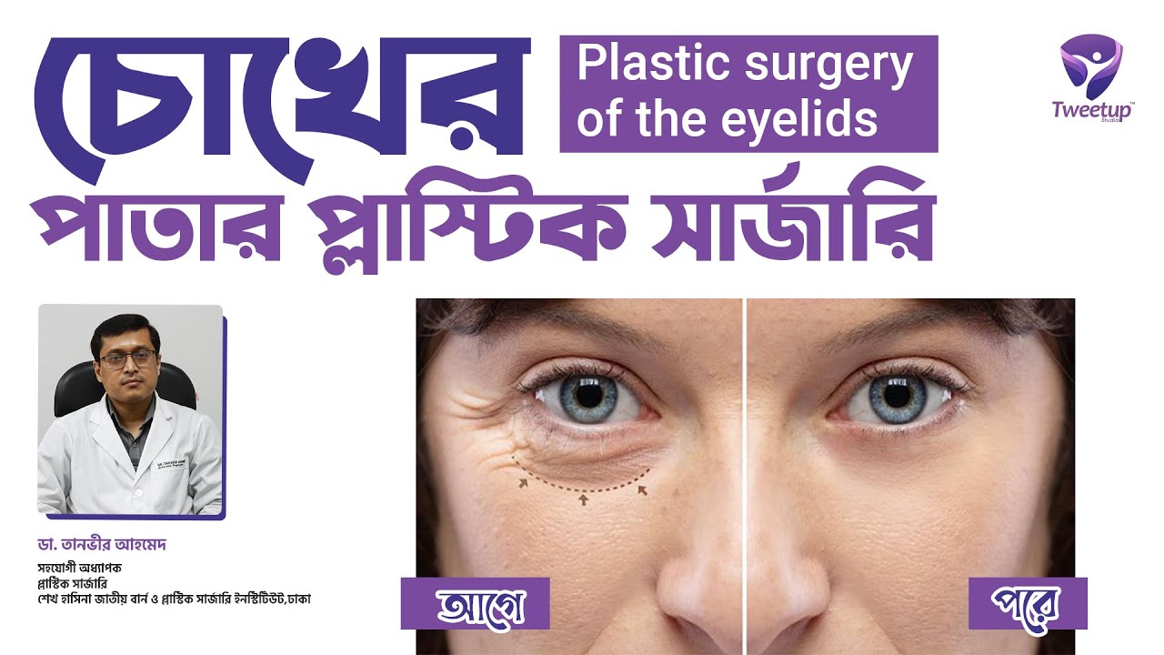 চোখের পাতার প্লাস্টিক সার্জারি । । Plastic surgery of the eyelids [4K]