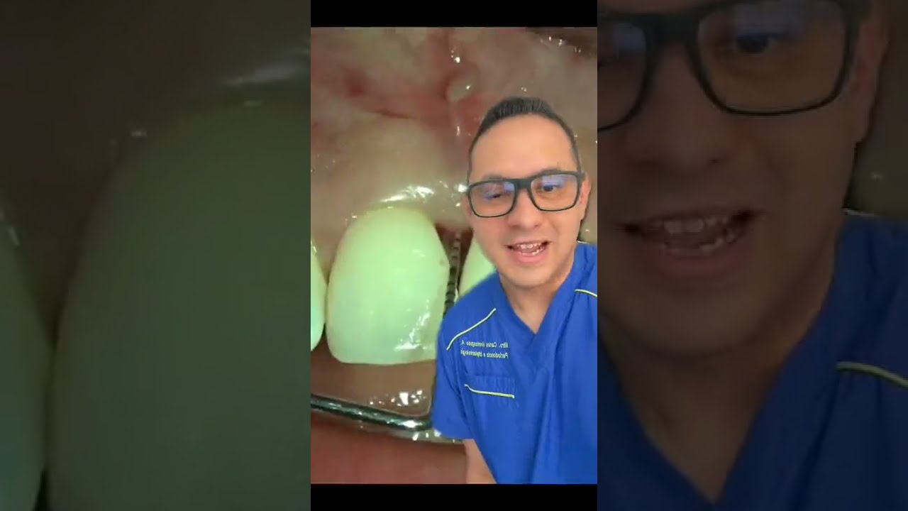Sondaje periodontal 🦷 TIkTok
