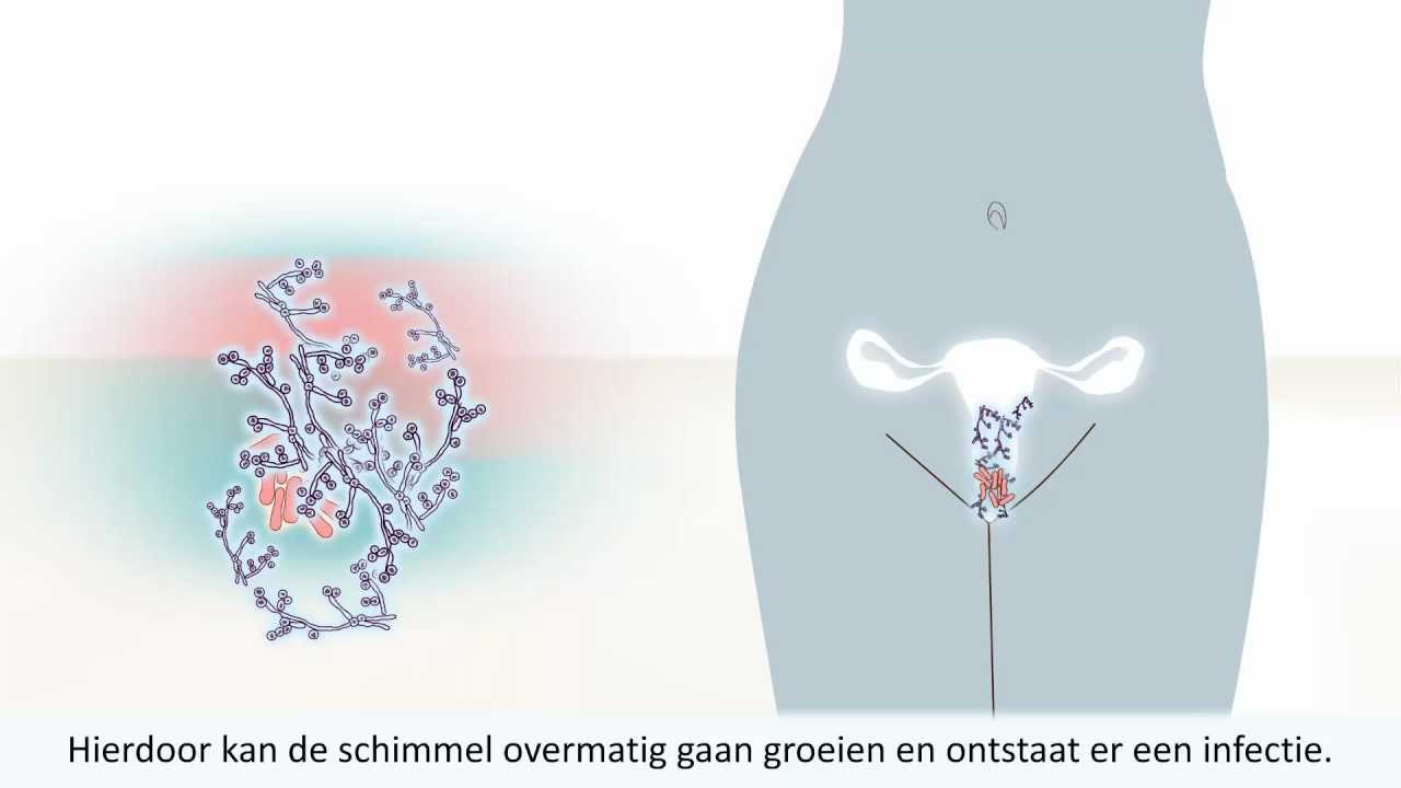 Vaginale schimmelinfectie - Wat is het en hoe is het te behandelen?