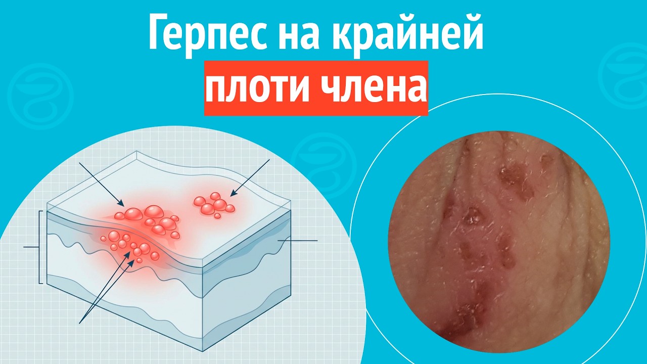 🥺 Герпес на крайней плоти члена. Клинический случай № 1723