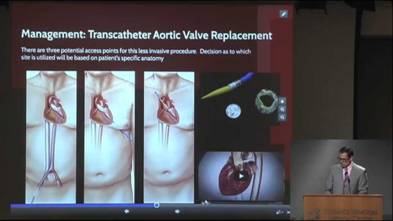 Understanding Aortic Stenosis and TAVR Procedure