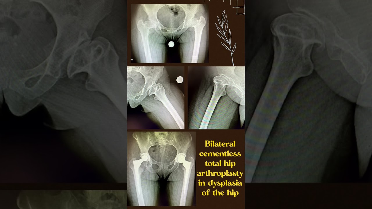 Bilateral cementless total hip arthroplasty in dysplasia of the hip#THA #dysplasia #hip #DDH