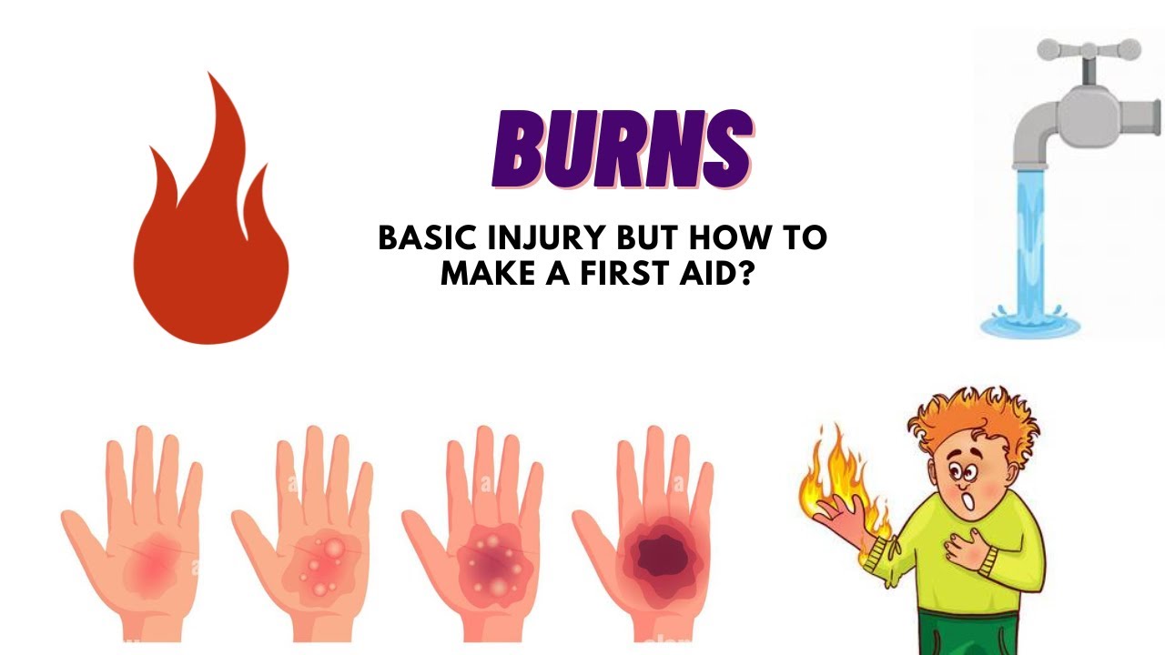 Burns - Degrees, size and first aid