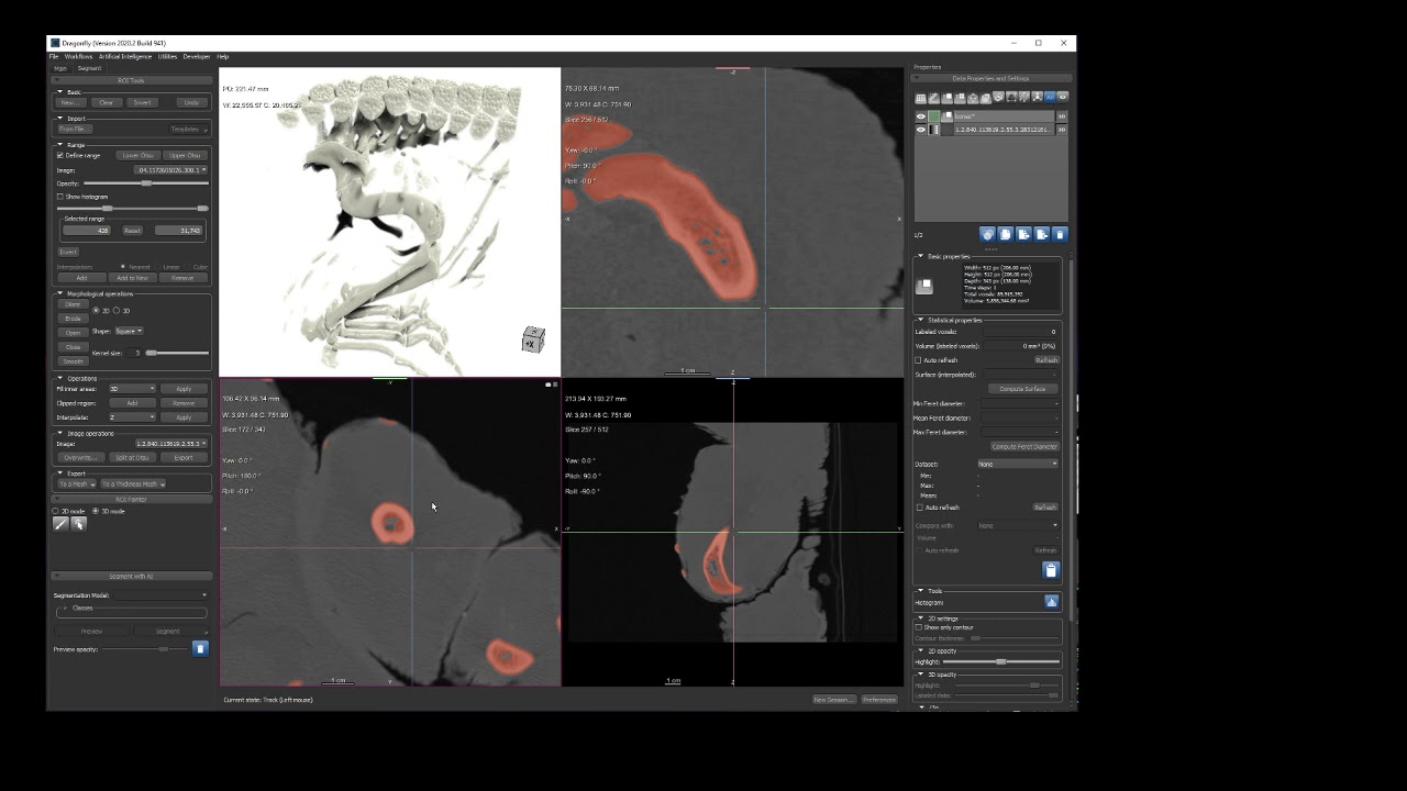 Segmenting CT Data in ORS Dragonfly
