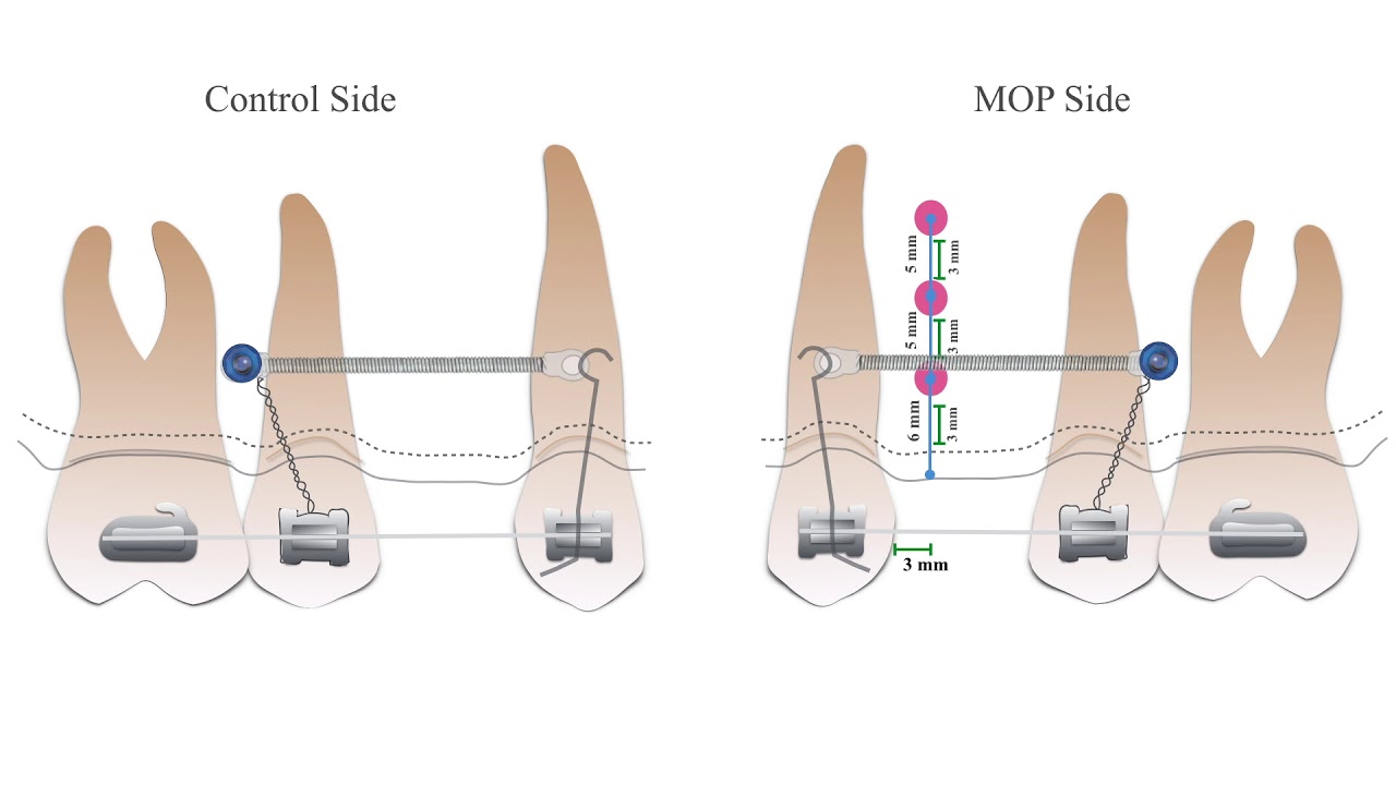 Three dimensional assessment of micro-osteoperforations on the rate of the tooth movement