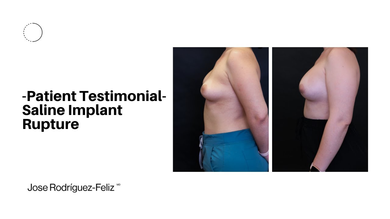 Patient Testimonial - Saline Implant Rupture
