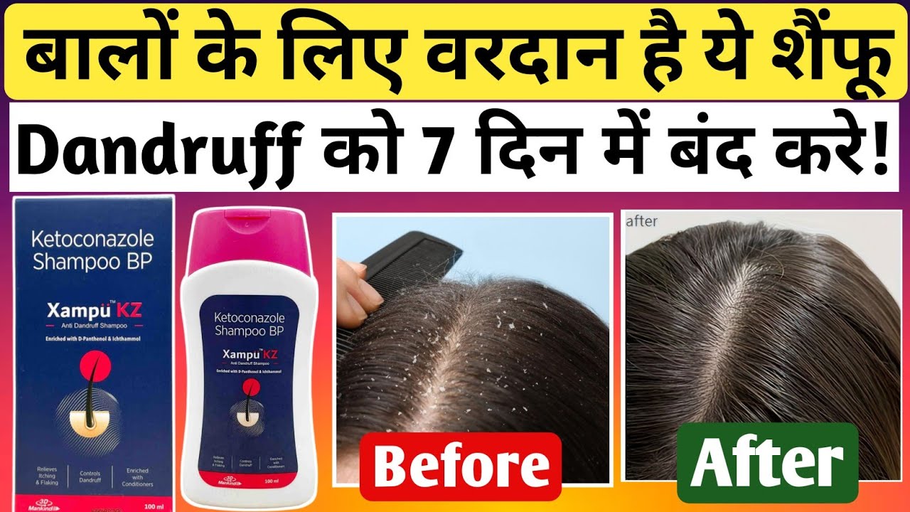 Xampu KZ Shampoo || Anti Dandruff Shampoo || Ketoconazole Shampoo || Dandruff Shampoo