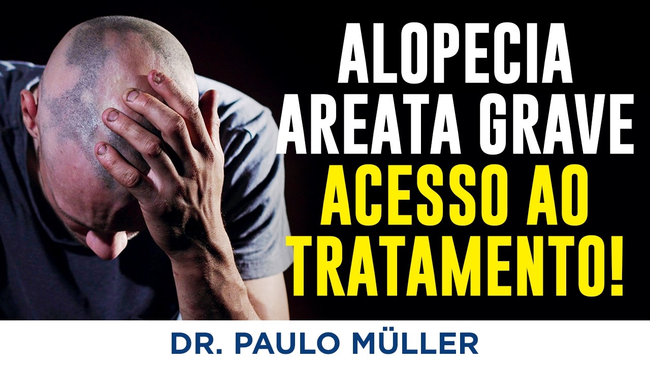 Alopecia Areata Grave: Tratamento Caro! Como Conseguir Acesso?