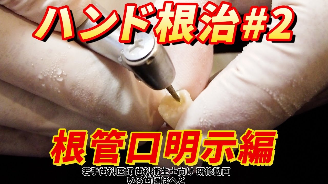 ハンド根治#2【根管口明示編】