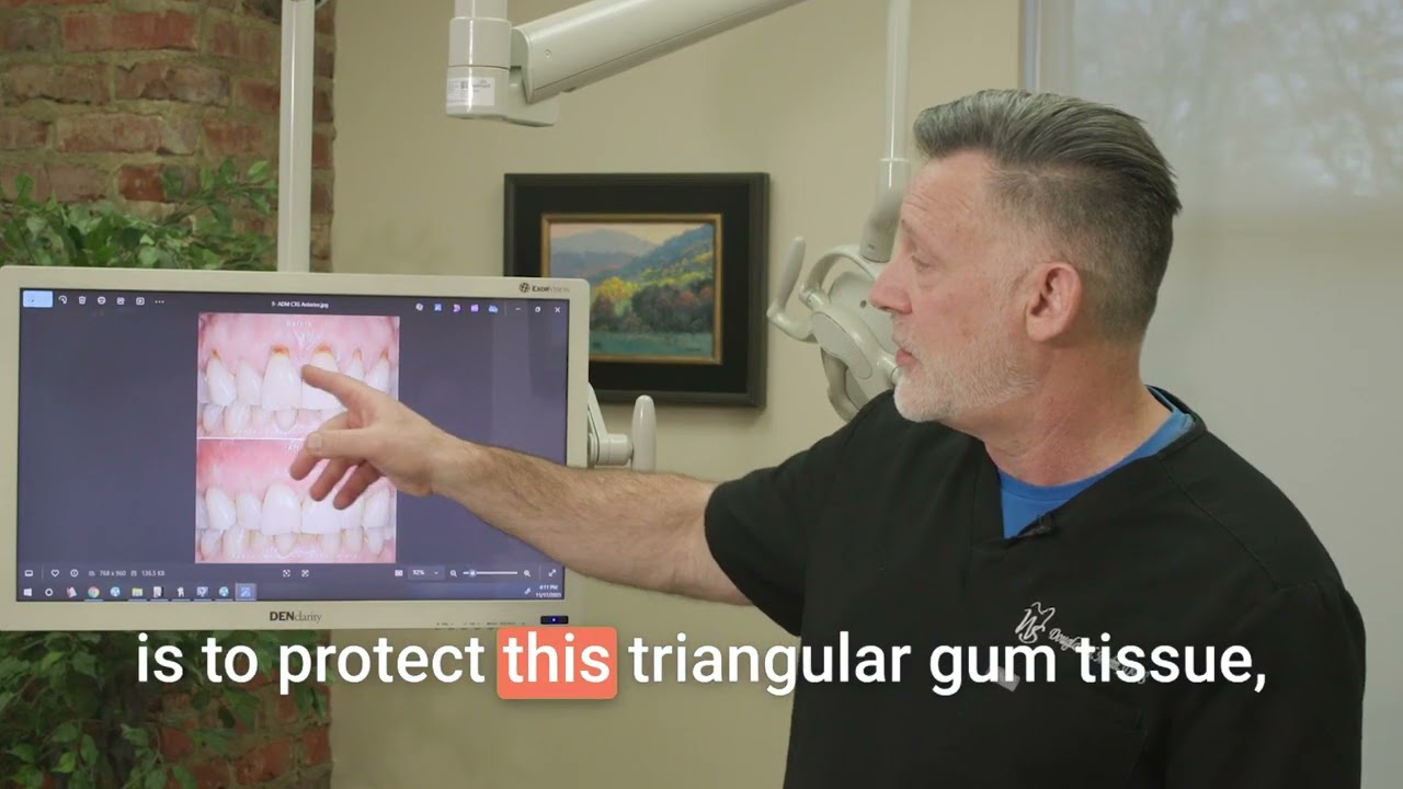 What is Gingival Recession? | A Complete Explanation