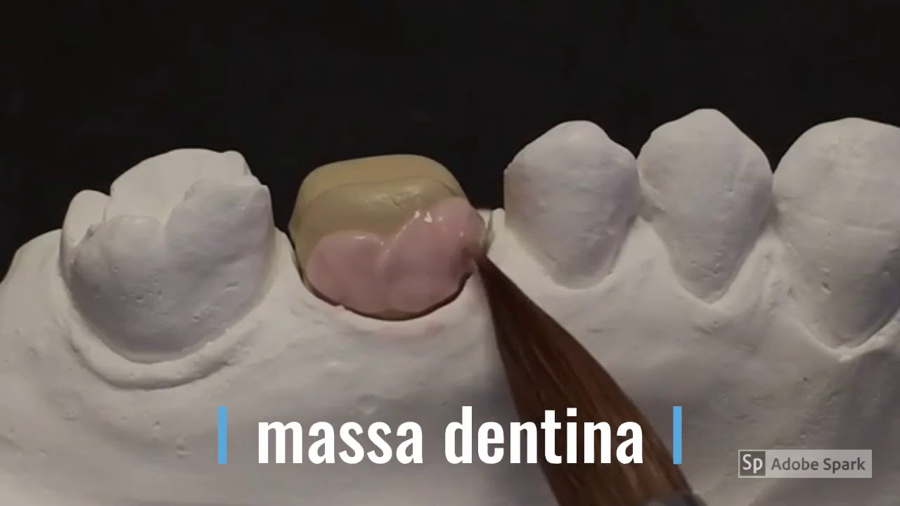 Videolezione Prof. Ciccone sulla stratificazione metallo ceramica