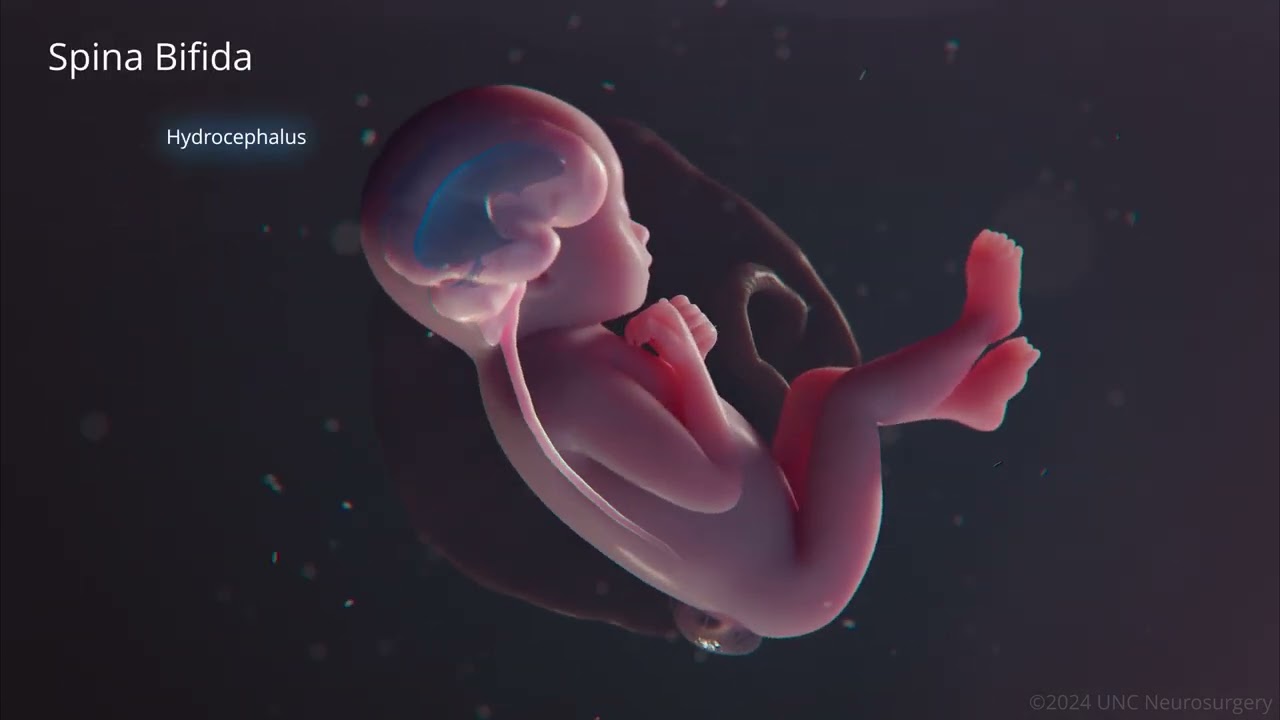 Spina Bifida 3D Animation - UNC Health Department of Neurosurgery