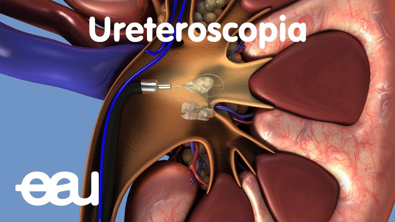 Tratamiento de c&aacute;lculos renales y ureterales: URS