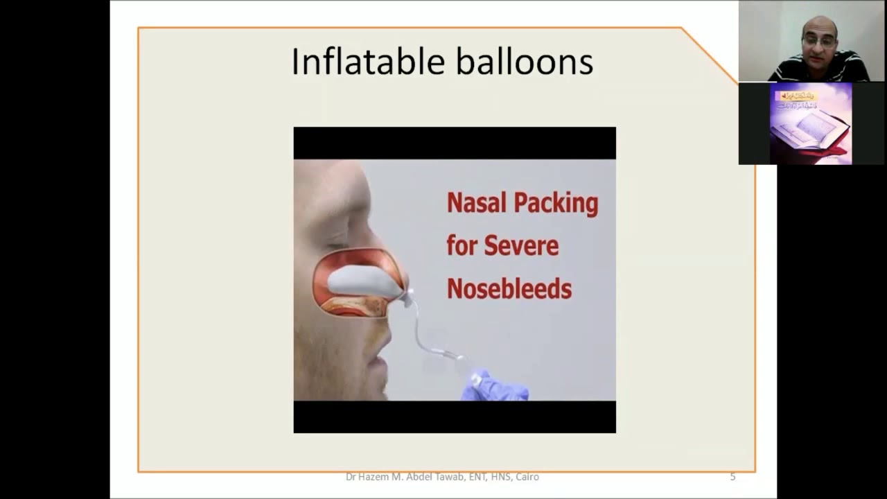 Epistaxis Causes and Management part 3