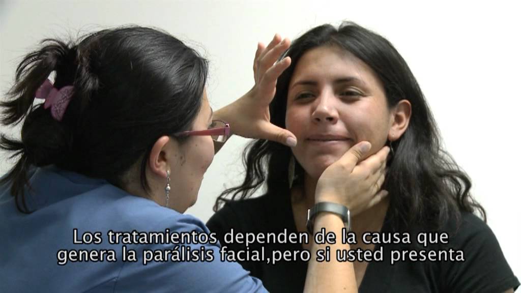 Parálisis Facial