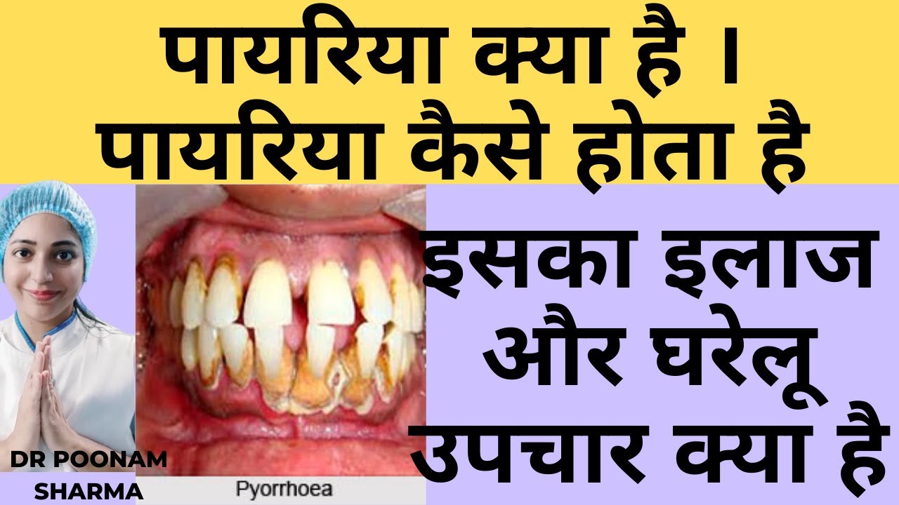 पायरिया क्या है | पायरिया कैसे होता है | पायरिया का इलाज और घरेलु उपचार | Treatment  Of Pyorrhea