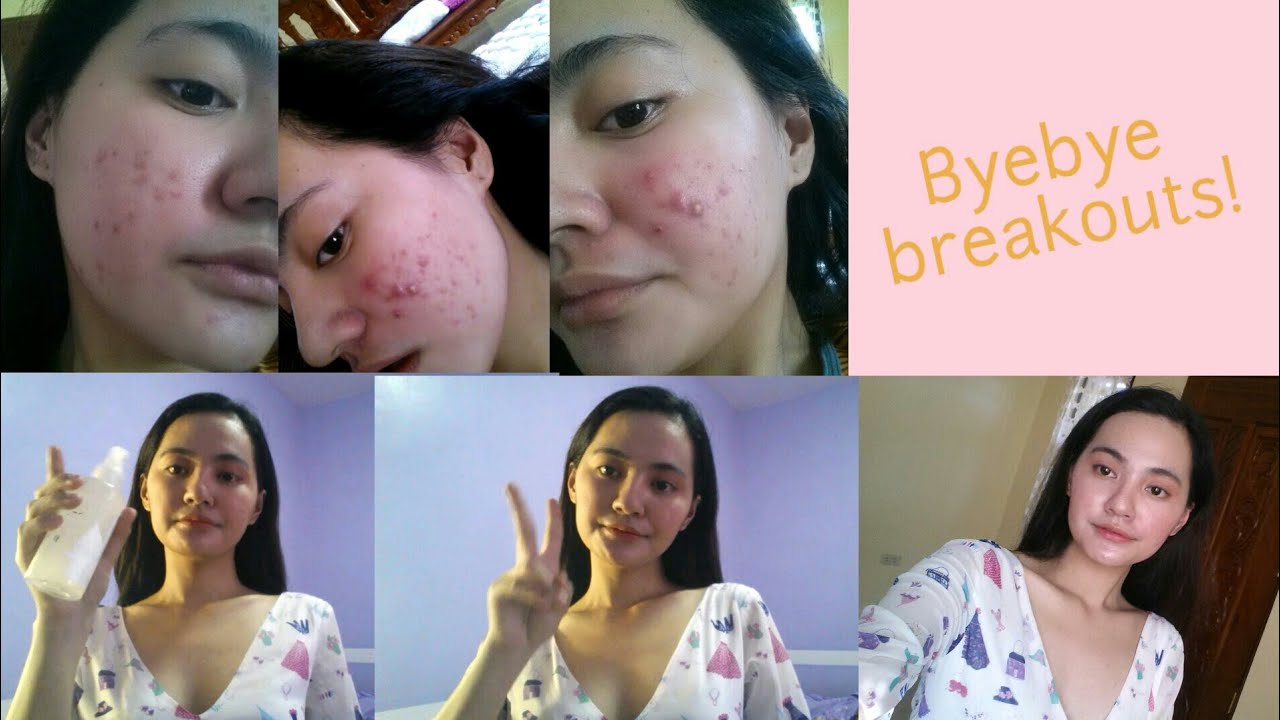 How I got rid of my ACNE (Maxipeel #3 + Rice Water)