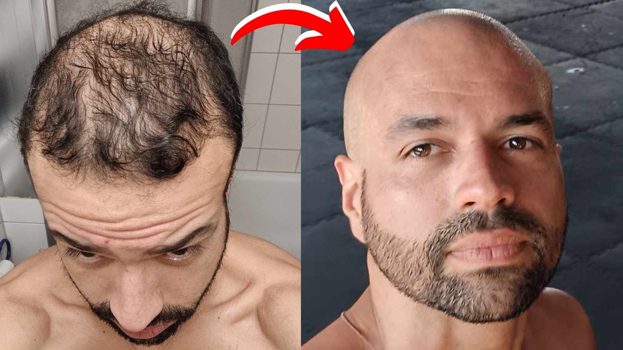I Was So Scared Of Going Bald...Until I Did This...