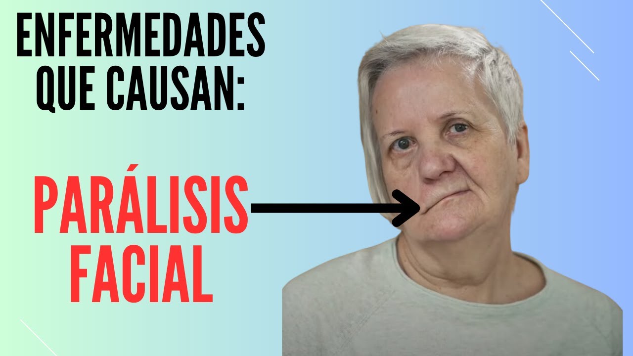 7 enfermedades que causan parálisis facial