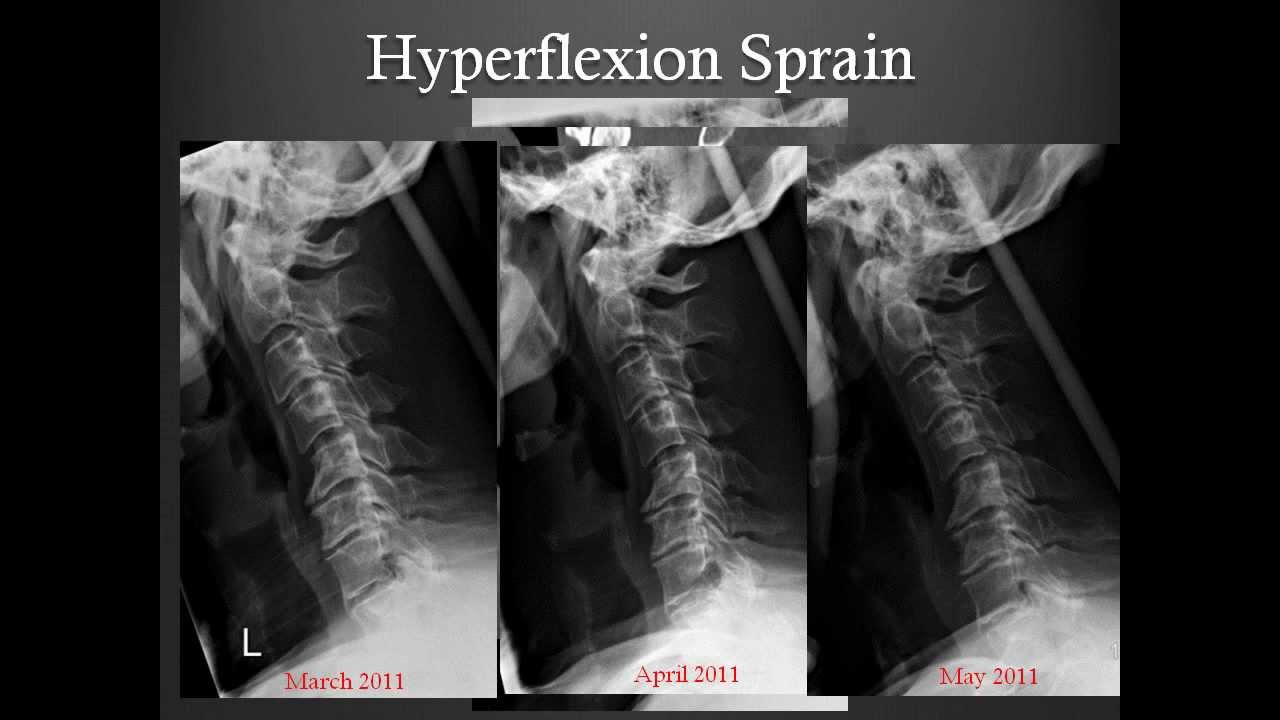 Easily Missed Musculoskeletal Injuries