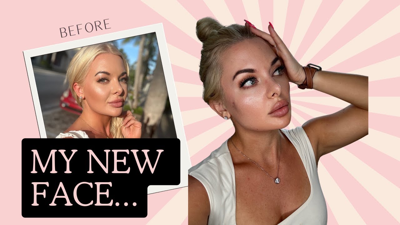 МГНОВЕННАЯ подтяжка лица! Нити PDO #pdothread #pdothreadlift