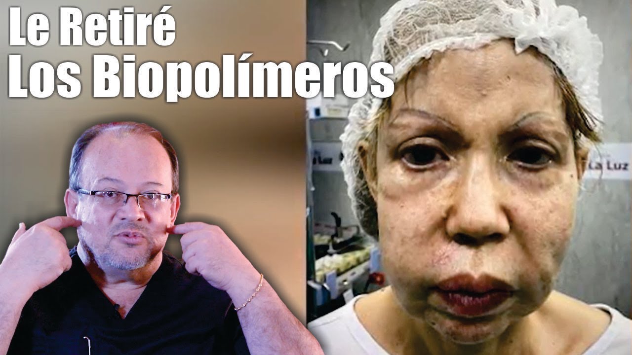 RETIRO DE BIOPOLIMEROS 💔 Cirugía Reconstructiva 💔 Aceite de Avión 💉 ALBERTO CALVO QUIROZ