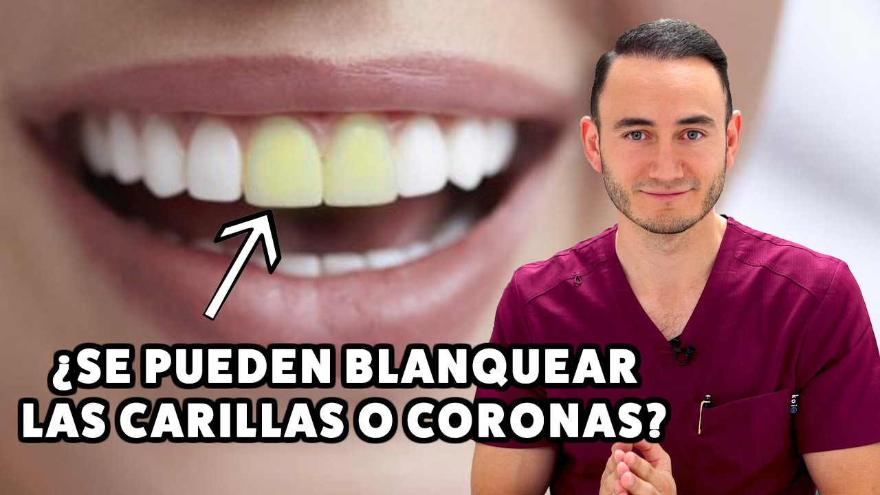 &iquest;Se pueden blanquear las carillas o coronas que ya tengo?