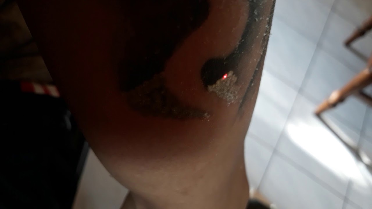 Hapus Tattoo Ethnic Studio, dengan laser,cuma 10ribuan