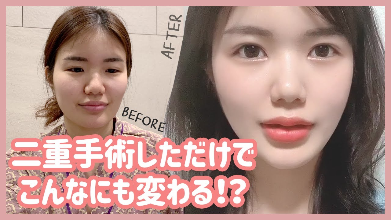 韓国美容整形外科のスタッフが受けた二重手術レポ＜第二弾＞