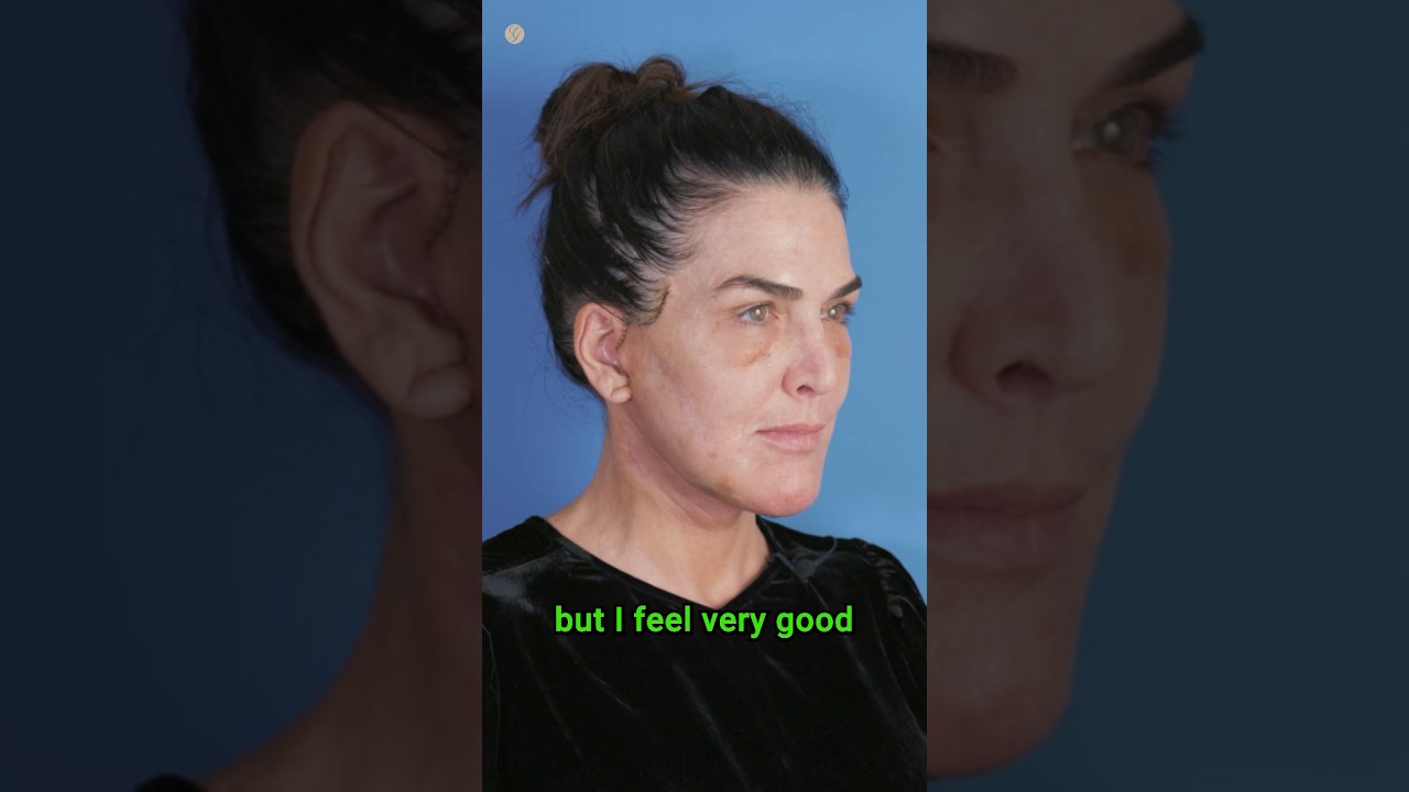 Only 8 Days After Preservation Facelift #antiaging