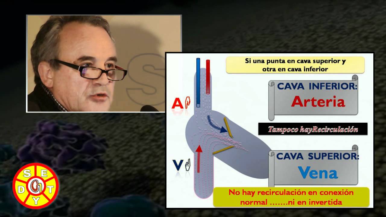 Tipos de accesos venosos. ACCESOS VASCULARES para HEMODIÁLISIS. Dr. Carlos Solozabal.